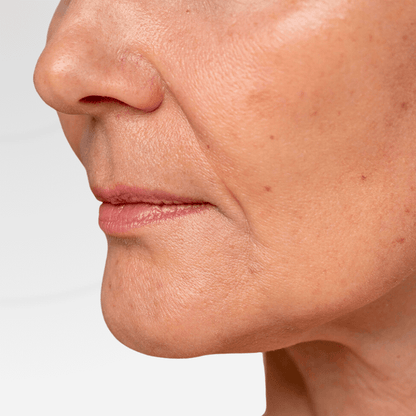 Non-Surgical Skin Tightening