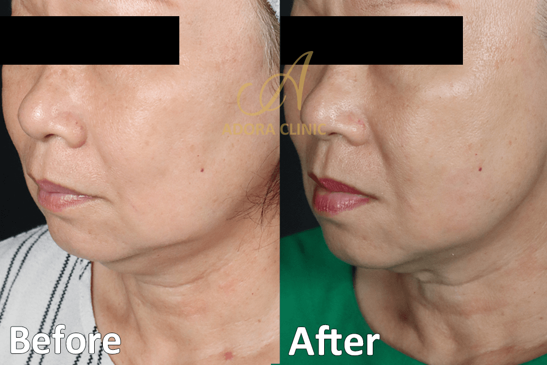 Non-Surgical Skin Tightening
