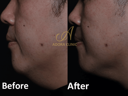 Non-Surgical Skin Tightening