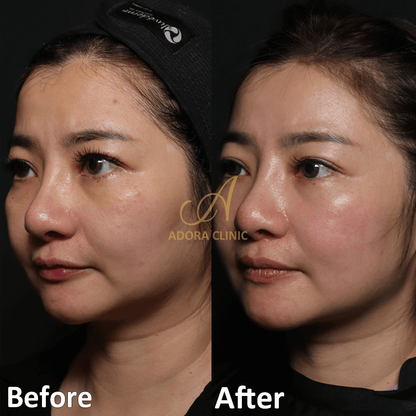 Non-Surgical Skin Tightening