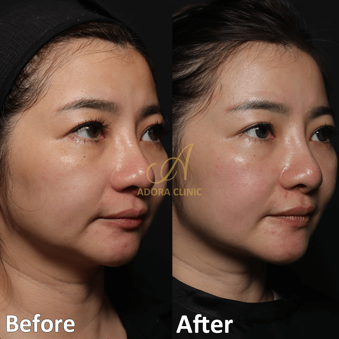 Non-Surgical Skin Tightening